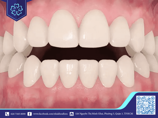 Khớp cắn hở có thể do di truyền hoặc thói quen xấu có thể điều trị bằng niềng răng khớp cắn hở hoặc bọc sứ