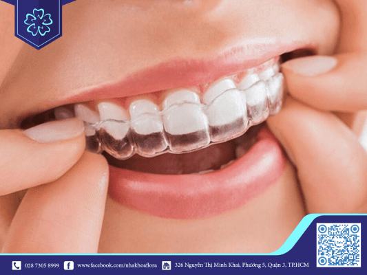 nieng-rang-khop-can-ho-bang-khay-trong-suot-invisalign Niềng răng khớp cắn hở bằng khay trong suốt Invisalign