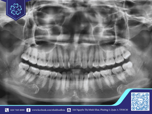 X-ray to ensure braces results