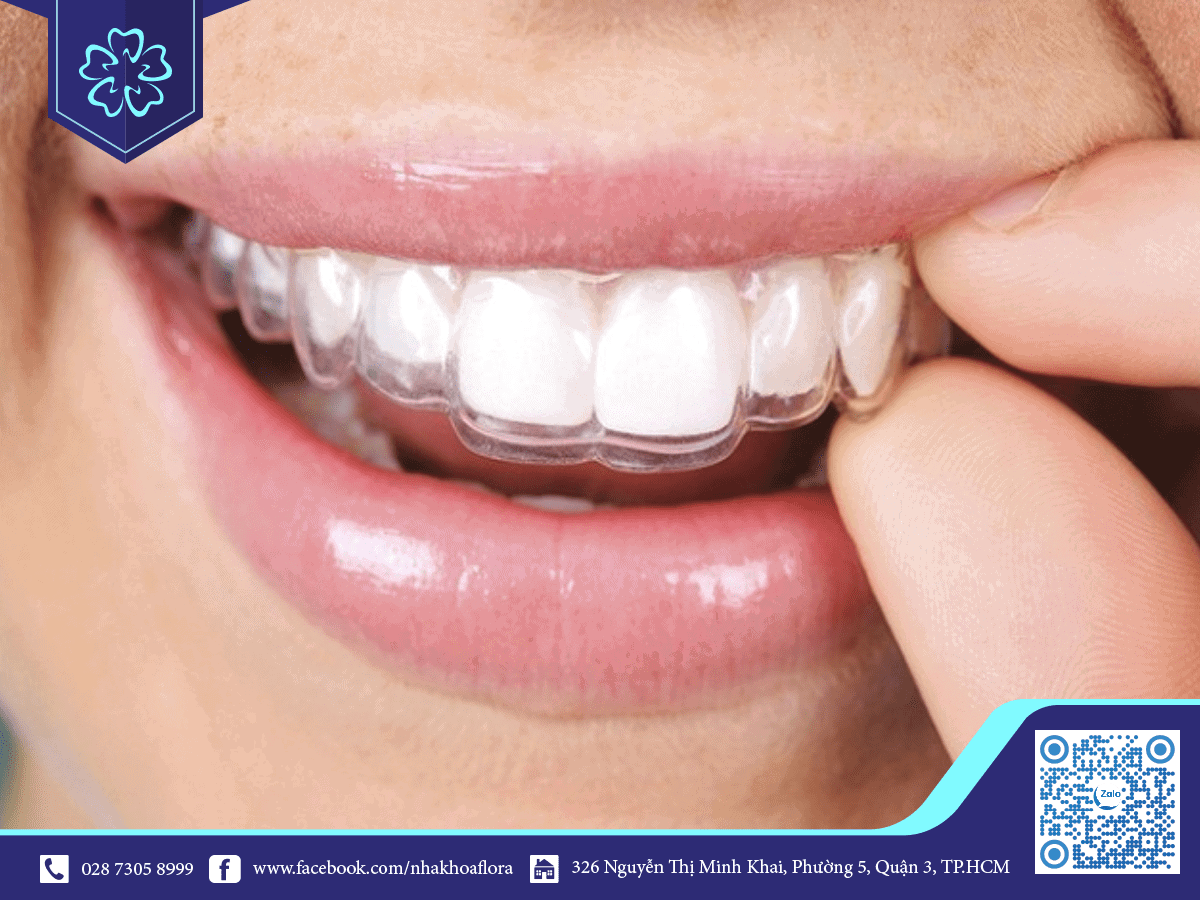 Niềng răng invisalign thiết kế chính xác cho mỗi trường hợp riêng biệt