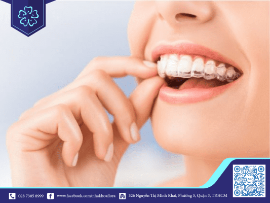 nieng-rang-dieu-tri-khop-can-hieu-qua Niềng răng điều trị khớp cắn hiệu quả