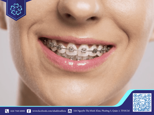 NIỀNG RĂNG CHỈNH NHA THẨM MỸ HOẠT ĐỘNG NHƯ THẾ NÀO? 3