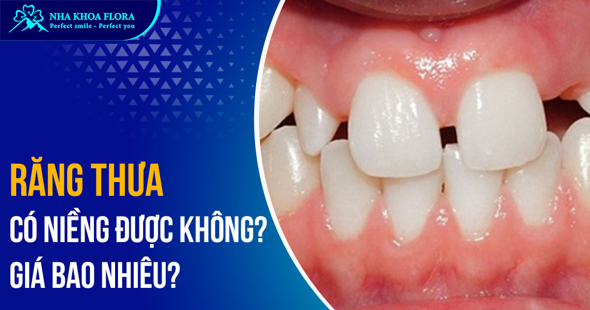 Răng thưa có niềng được không? Giá bao nhiêu tiền?