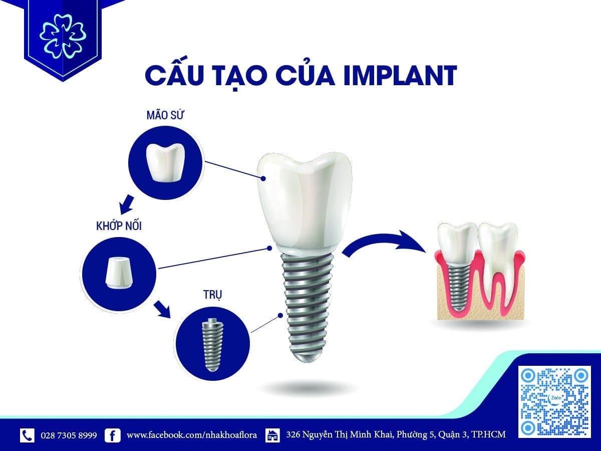 cấu tạo của răng trồng implant