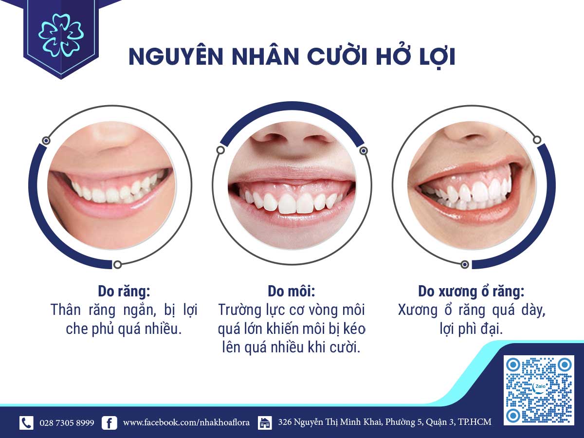 Nguyên nhân cười hở lợi Nguyên nhân cười hở lợi