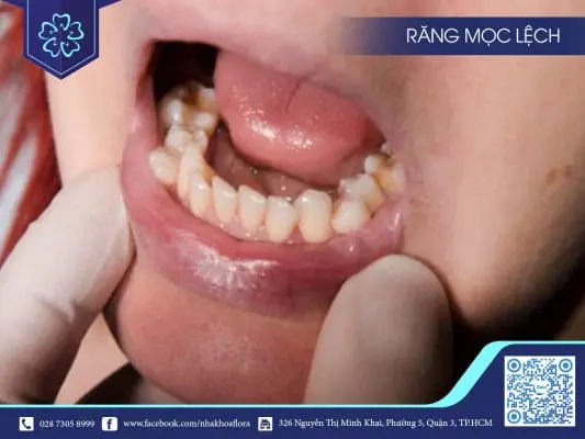 NGUYÊN NHÂN NÀO KHIẾN RĂNG MỌC LỆCH? CHỌN PHƯƠNG PHÁP NIỀNG RĂNG PHÙ HỢP TỐT CHO BẠN RA SAO 2