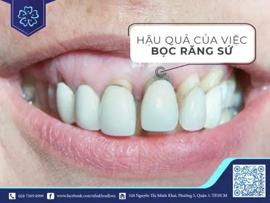 TÌM HIỂU VỀ HẬU QUẢ CỦA VIỆC BỌC RĂNG SỨ 7