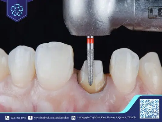 MÀI CÙI RĂNG CÓ ĐAU VÀ ẢNH HƯỞNG GÌ KHÔNG? 4