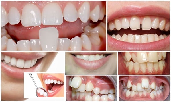 Những hàm răng cần bọc răng sứ