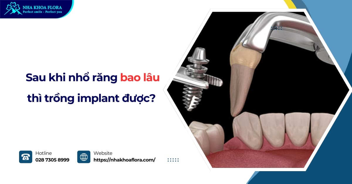 [Hỏi đáp]: Sau khi nhổ răng bao lâu thì trồng implant được?