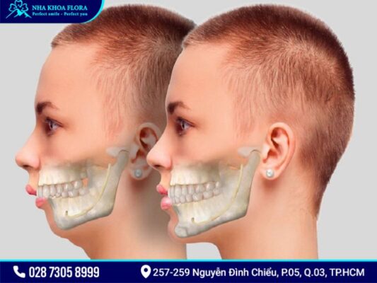 cười hở lợi và hàm hô vẩu - ảnh 1 cười hở lợi và hàm hô vẩu - ảnh 1