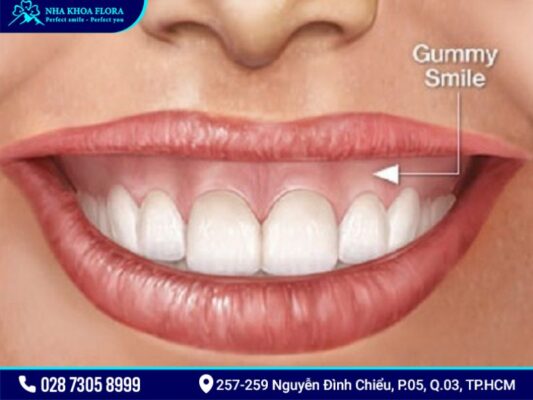 cười hở lợi và hàm hô vẩu - ảnh 2 cười hở lợi và hàm hô vẩu - ảnh 2