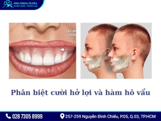 cười hở lợi và hàm hô vẩu - ảnh 3 cười hở lợi và hàm hô vẩu - ảnh 3