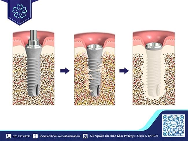Dental restoration on implants