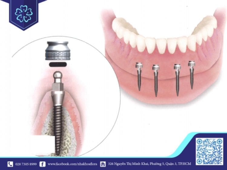 Nên lựa chọn kích thước trụ Implant phù hợp để tối ưu hiệu quả trồng răng Implant