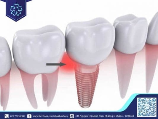 Tình trạng viêm xung quanh trụ implant khi trồng răng Implant