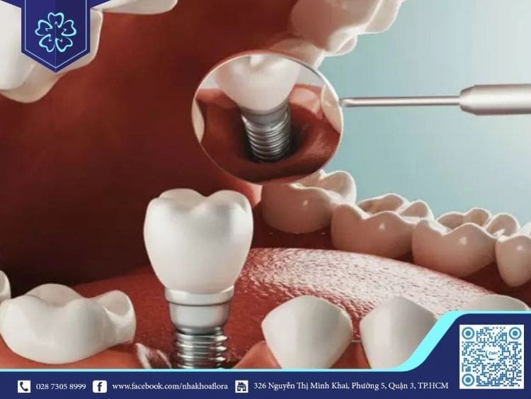 Phương pháp trồng răng Implant giúp bạn phục hồi lại răng mất như răng thật 