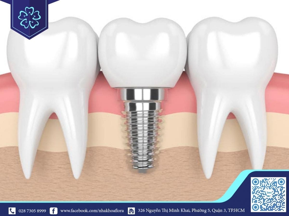 lợi ích của trồng răng implant là phục hồi răng mất