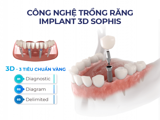 Công nghệ trồng răng 3D Sophis chuẩn Thuỵ Sỹ