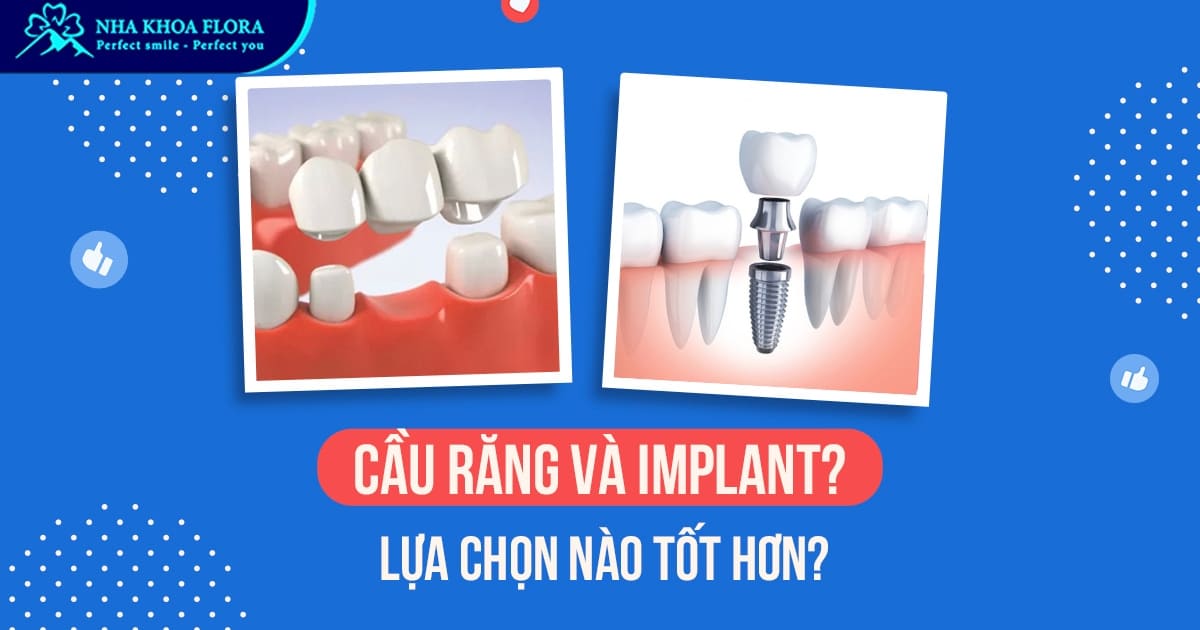 Cầu răng sứ và Implant? Nên lựa chọn phương pháp trồng răng nào?