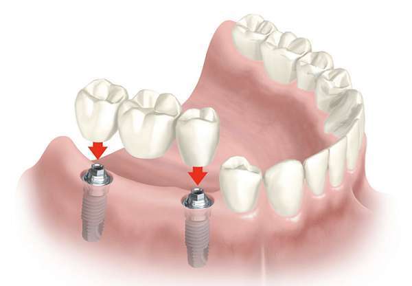 Cầu răng bằng implant hỗ trợ điều kiện tài chính tốt nhất