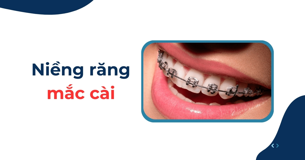 Niềng răng mắc cài là gì? Có tốt hay không? Giá bao nhiêu?