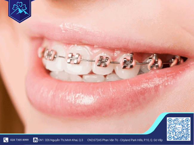 Niềng răng mắc cài Niềng răng mắc cài