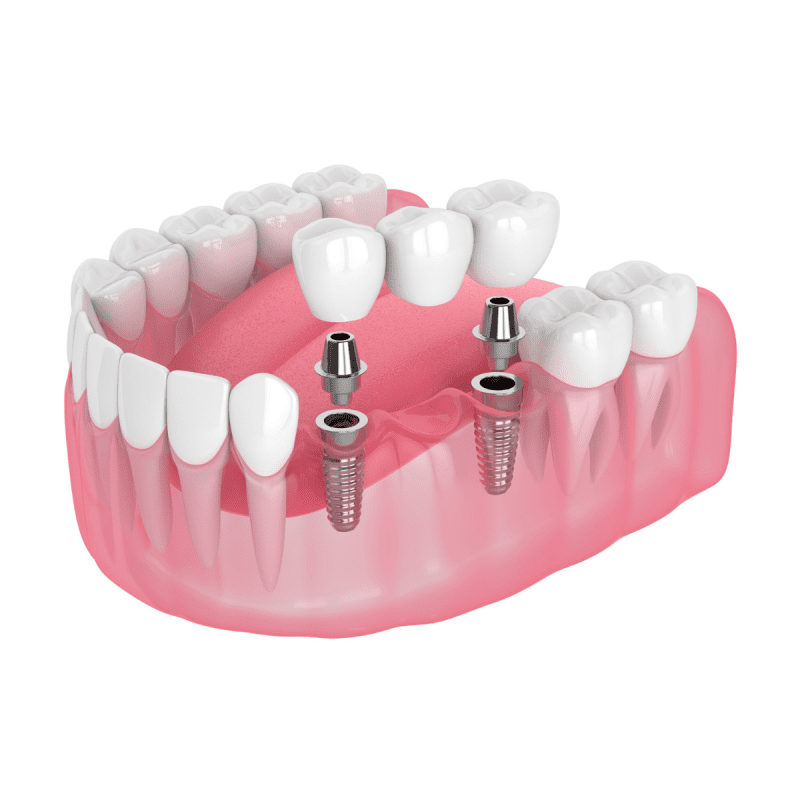 Trồng răng Implant liền kề