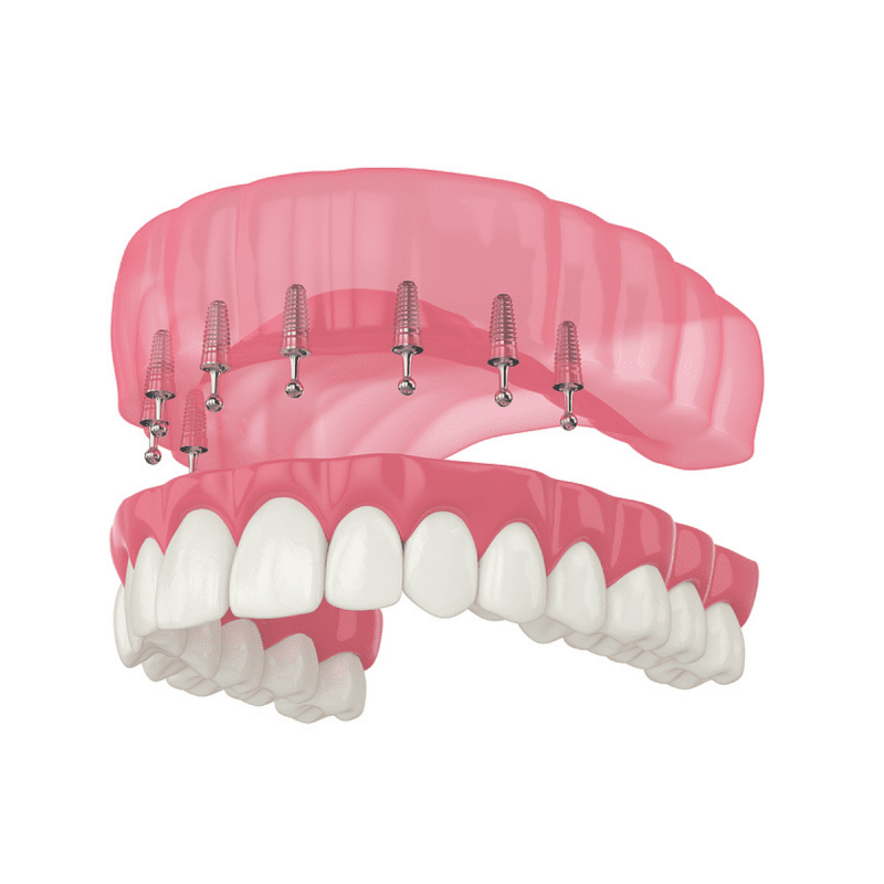 hàm implant- trồng răng implant