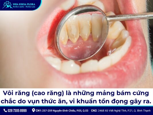lưu ý sau khi cạo vôi răng - ảnh 1 lưu ý sau khi cạo vôi răng - ảnh 1