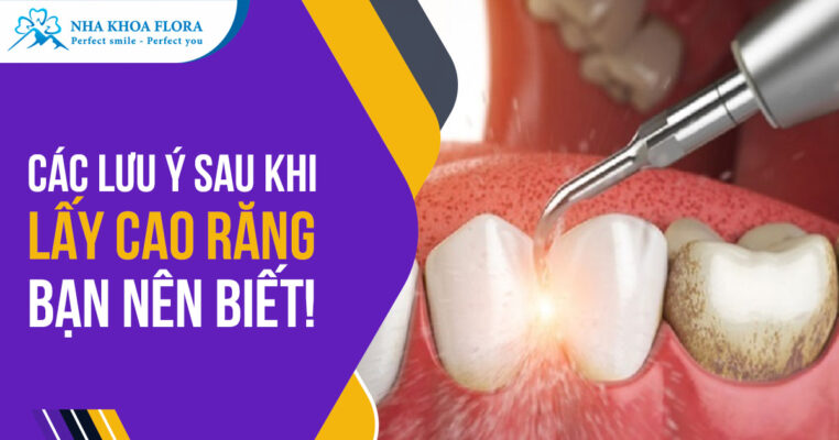 Lưu ý sau khi lấy cao răng