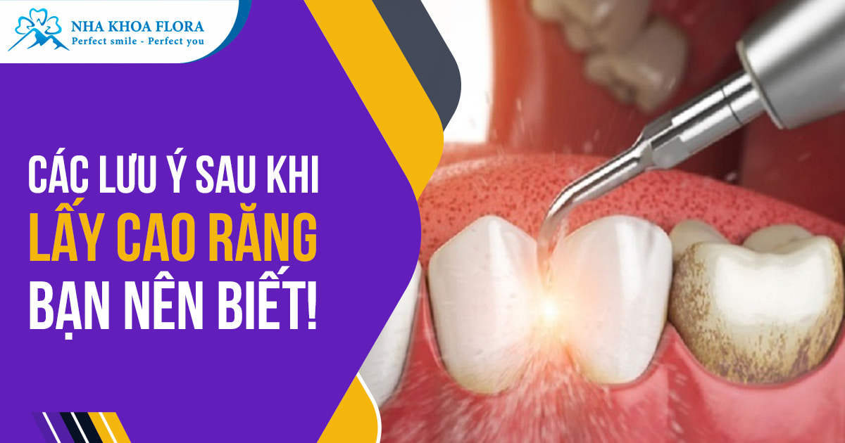 Các lưu ý sau khi cạo vôi răng bạn nên biết khi thực hiện