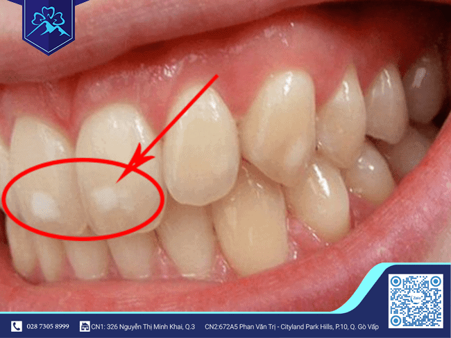Răng có nguy cơ bị nhiễm Fluor