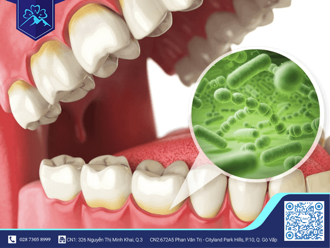Vệ sinh răng miệng kém tạo điều kiện để vi khuẩn phát triển