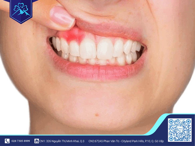 Khái niệm viêm nha chu Khái niệm viêm nha chu