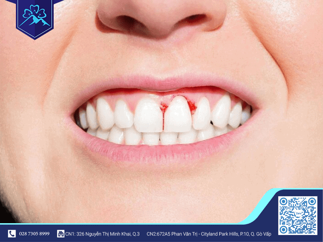 Nếu không điều trị hết bệnh lý răng miệng trước khi bọc răng sứ, khách hàng có nguy cơ bị viêm nướu