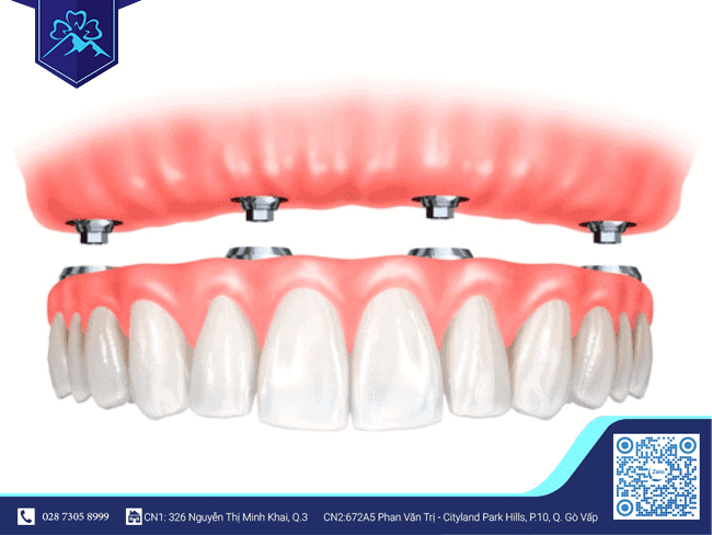 Số lượng đặt trụ Implant với tình trạng mất răng liền kề