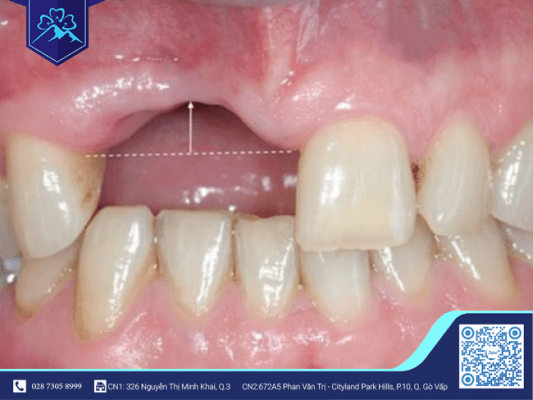 VÌ SAO MẤT 3 RĂNG LIỀN KỀ CHỈ CẦN CẤY 2 TRỤ IMPLANT? 2