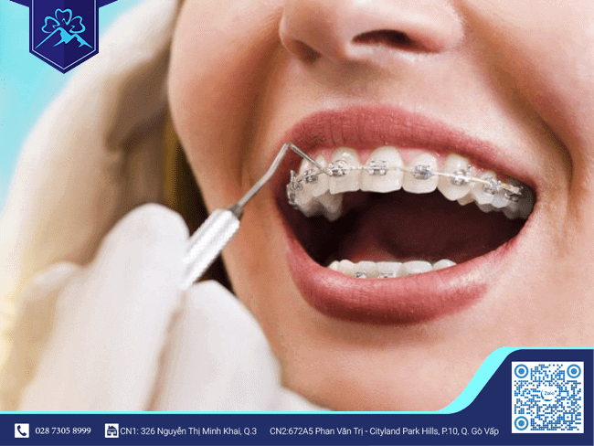 Với nguyên nhân răng nghiêng do bẩm sinh, bác sĩ tại Nha Khoa Flora khuyên bạn đọc nên niềng răng