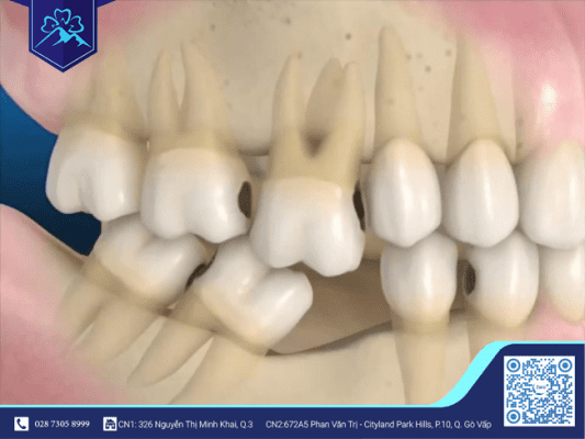 Răng bị nghiêng vào vùng mất răng