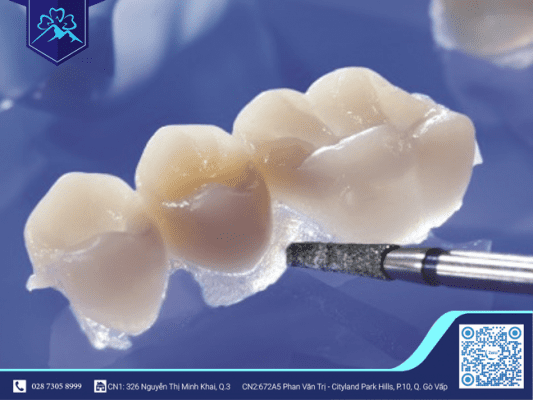 RĂNG GIẢ TẠM THỜI LÀ GÌ? KHI NÀO CẦN GẮN RĂNG GIẢ NÀY? 1