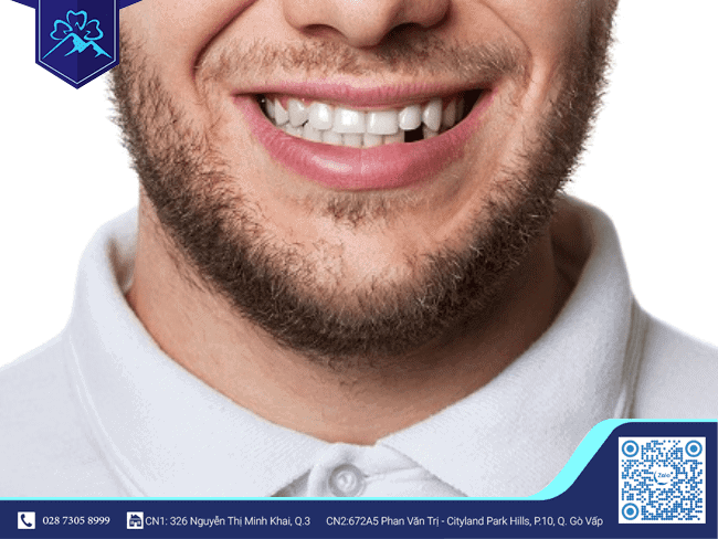 Tình trạng mất răng sớm là như thế nào? Tình trạng mất răng sớm là như thế nào?