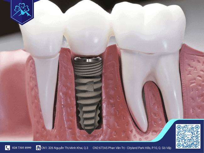 Hiện tượng dị ứng trồng răng Implant là rất hiếm