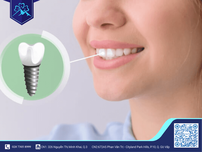 Trồng răng implant đón tết