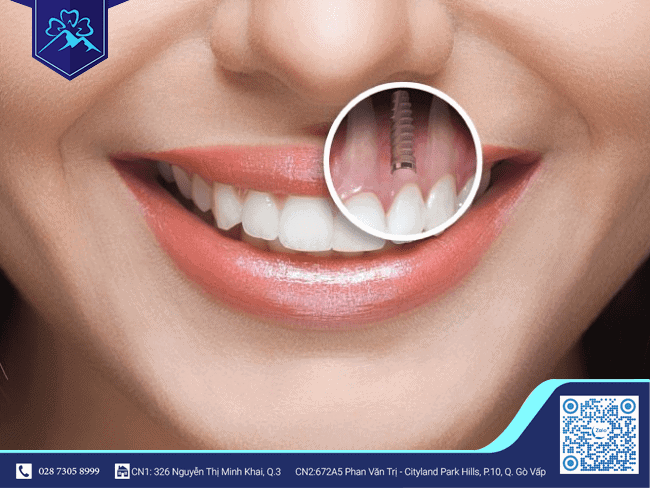 Phương pháp trông răng Implant