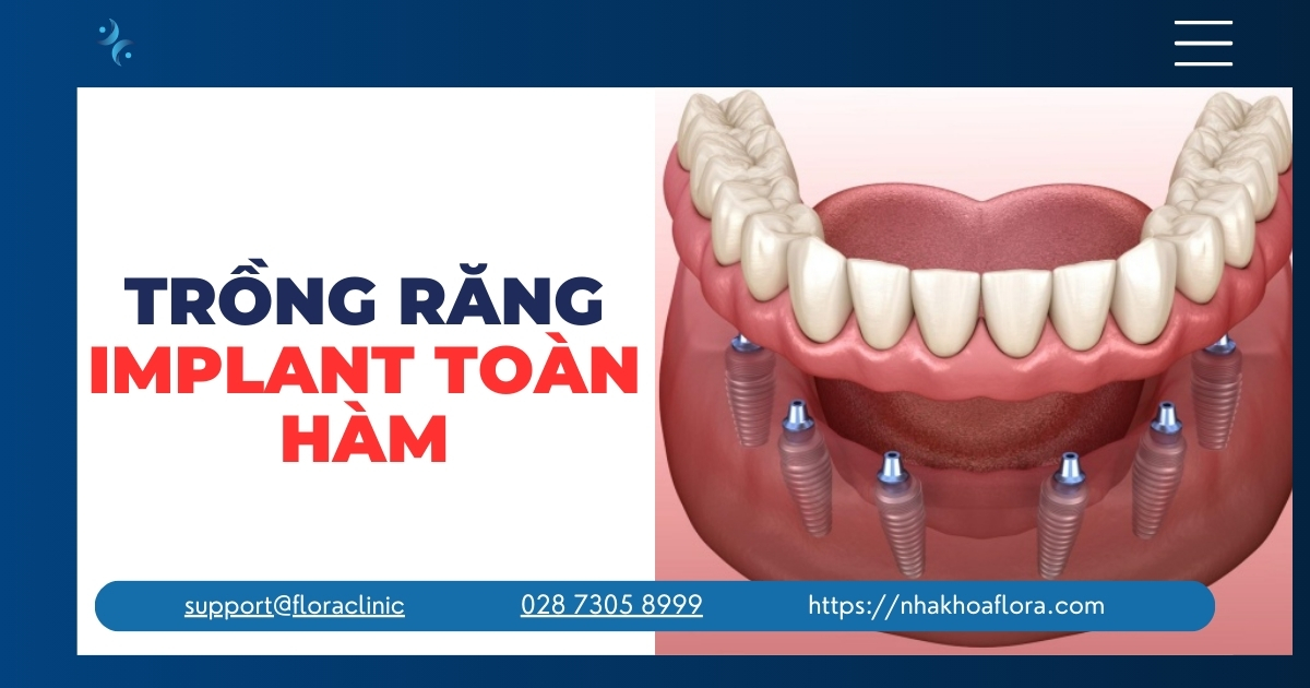 Implant All On 4 và All On 6 Là Gì? Có nên Lựa chọn Không?