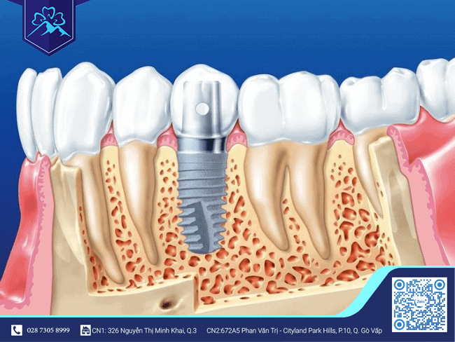 Phương pháp phục hồi răng toàn diện - Trồng răng Implant