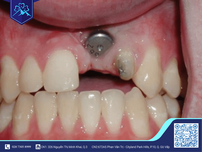 Một số điều kiện khác ngoài vấn đề bao nhiêu tuổi thì trồng răng Implant 