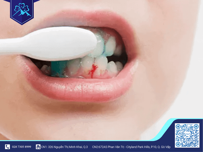 Không nên chải răng quá mạnh, tránh tình trạng chảy máu nướu