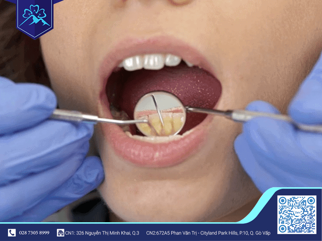 Chăm sóc răng miệng bằng cách đến Nha Khoa lấy cao răng định kỳ